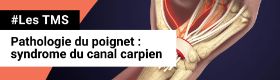 TMS - Pathologie du poignet - Syndrome du canal carpien