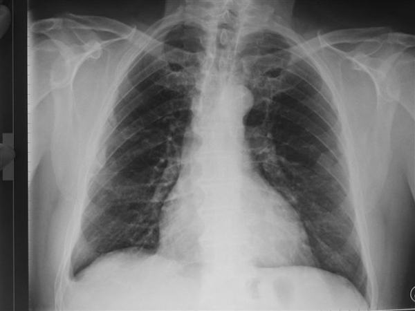 Radiographie des poumons montrant une pathologie liée à l’amiante Radiographie des poumons montrant une pathologie liée à l’amiante